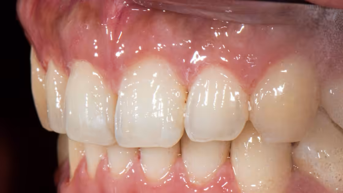 Case 3-after-teeth