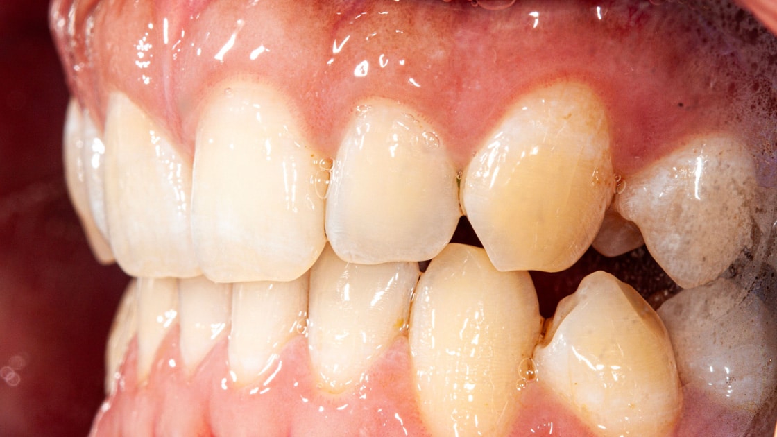 Case 5before-teeth